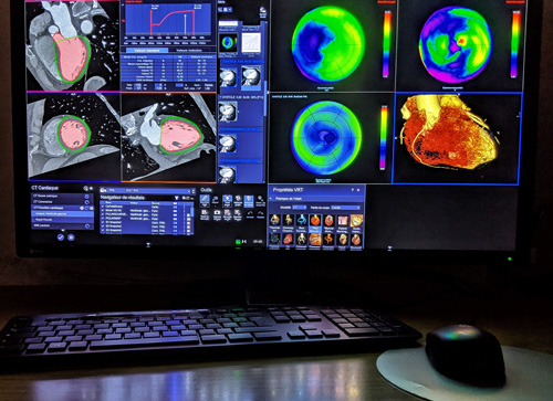 Scanner Imagerie cardiaque