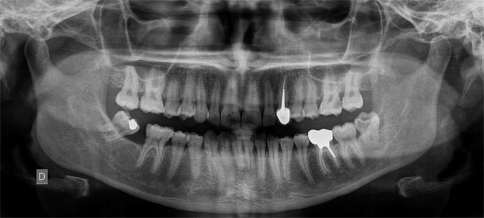 Panoramique dentaire